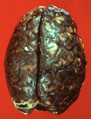 subarachnoid hemorrhage