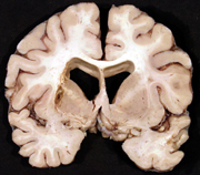 lacunar infarct