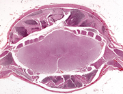 cerebellar tonsil herniation