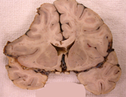 subdural hematoma