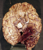 posteriorcerebral artery infarct