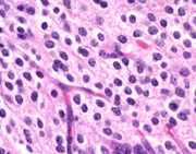 oligodendroglioma