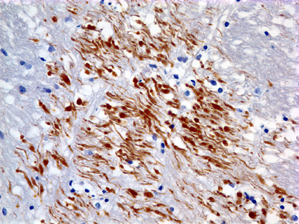 diffuse axonal injury