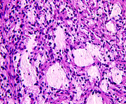 pilocytic astrocytoma