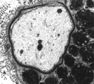 metachromatic leukodystrophy