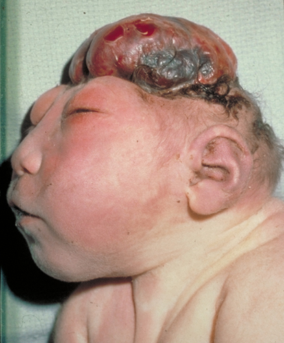 Causes Of Anencephaly