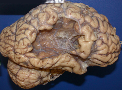 management of ischemic stroke