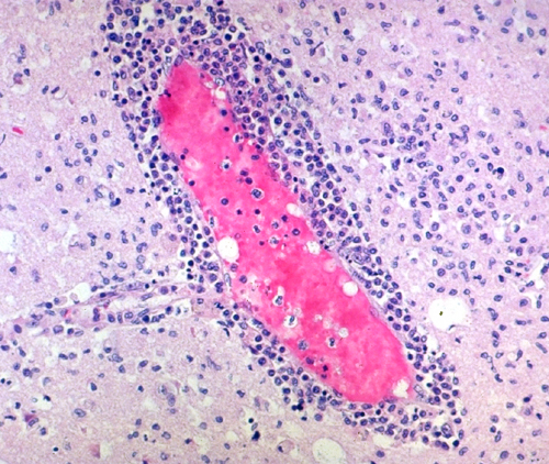 Picture Of Encephalitis