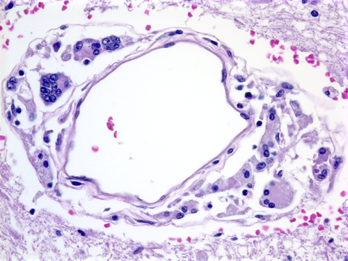 Hiv Csf Cells