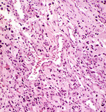 Clear Cell Ependymoma