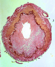 bacterial vasculitis