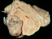 coustic schwannoma