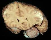 meningioma