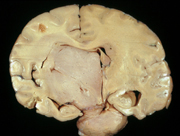 astrocytoma