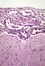 meningeal carcinomatosis