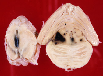 Brainstem hemorrhages