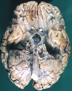 Contre-coup contusions