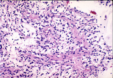 Posterior fossa lesion
