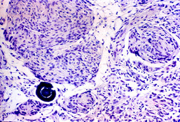Meningioma