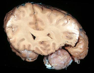 Meningioma gross