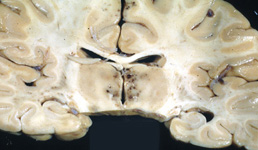 Brain pathology image