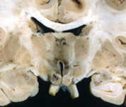Brain pathology image